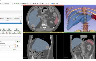 AI-assisted segmentation
AI-assisted annotation tools can automatically segment anatomical structures using pre-trained or custom models.
