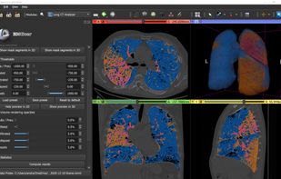 Lung CT analysis for COVID-19
LungCTAnalyzer extension offers automated lung segmentation and quantative analysis for COVID-19 cases.