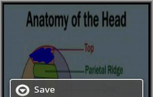 Migraine Pic screenshot 2